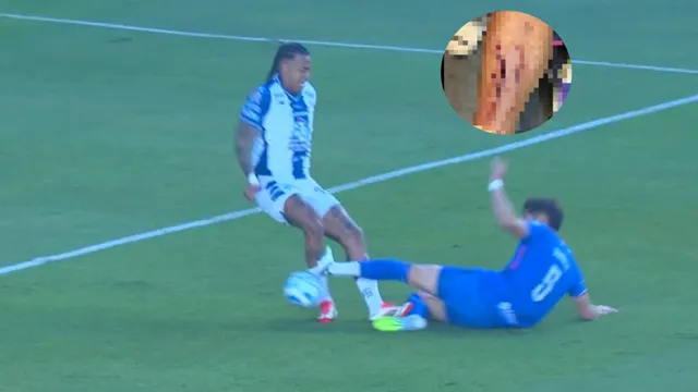 Impactante imagen: el estado de la pierna del Chiquete Orozco tras su roja ante Pachuca