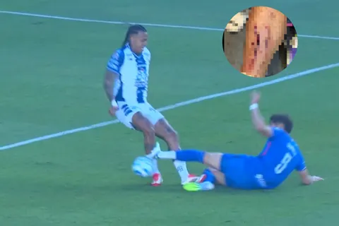 Impactante imagen: el estado de la pierna del Chiquete Orozco tras su roja ante Pachuca